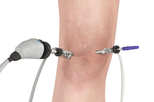 Arthroscope For Knee Treatment